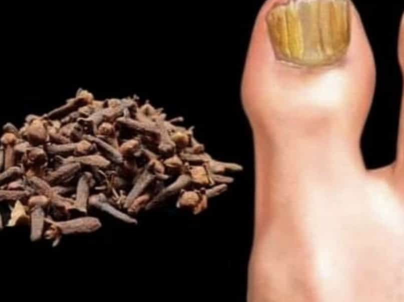 Removes Nail Fungus Instantly, Like an Eraser! The Best Remedy!