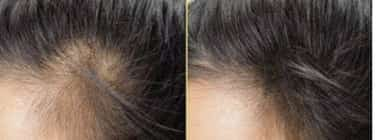 The Indian Secret: Using Cloves to Promote Rapid Hair Growth and Treat Baldness