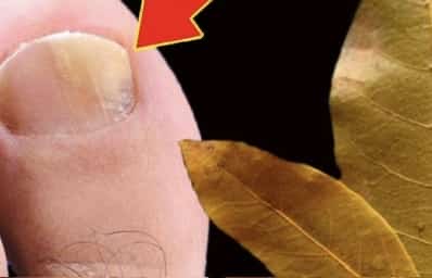 Eliminate Nail Fungus Instantly with Bay Leaves! Don’t Spend Any More Money at the Pharmacy!