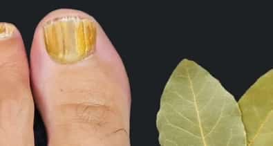 How to Eliminate Nail Fungus Quickly and Permanently with Bay Leaves! 