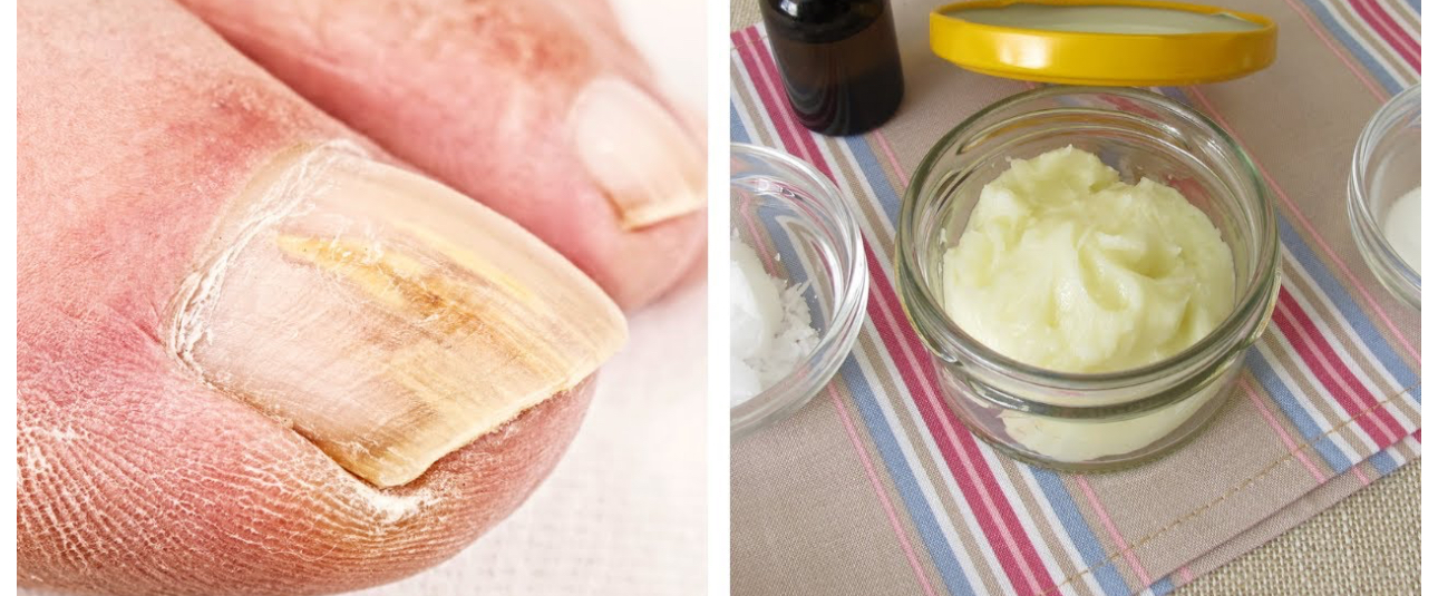 Garlic Paste: The Secret to Banishing Toenail Fungus for Good