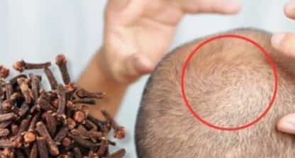 At 75, Hair Grows on a Bald Spot! How Clove Oil Can Stimulate Hair Growth